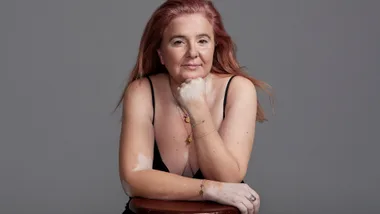 Renowned Makeup Artist Isabella Schimid On Her Journey With Vitiligo